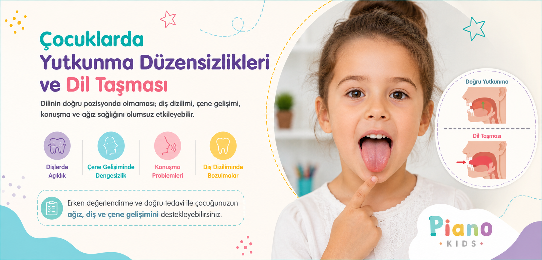 Dil Taşması veya Yutkunma Düzensizliği | Ankara Çocuk Diş Kliniği Çocuklar için yutkunma düzensizlikleri ve dil taşması hakkında bilgilendirici renkli afiş, sağda çocuk ağzı diagramıyla görsel destekli.